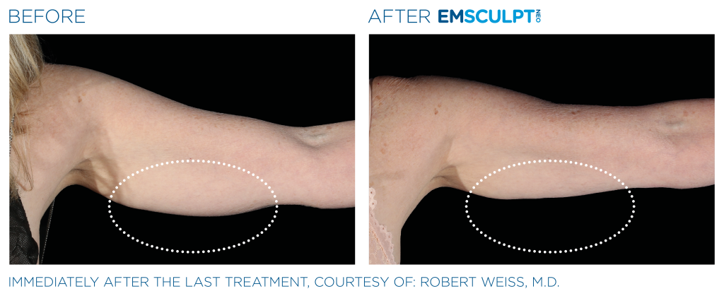 EMSCULPT NEO® pour les bras