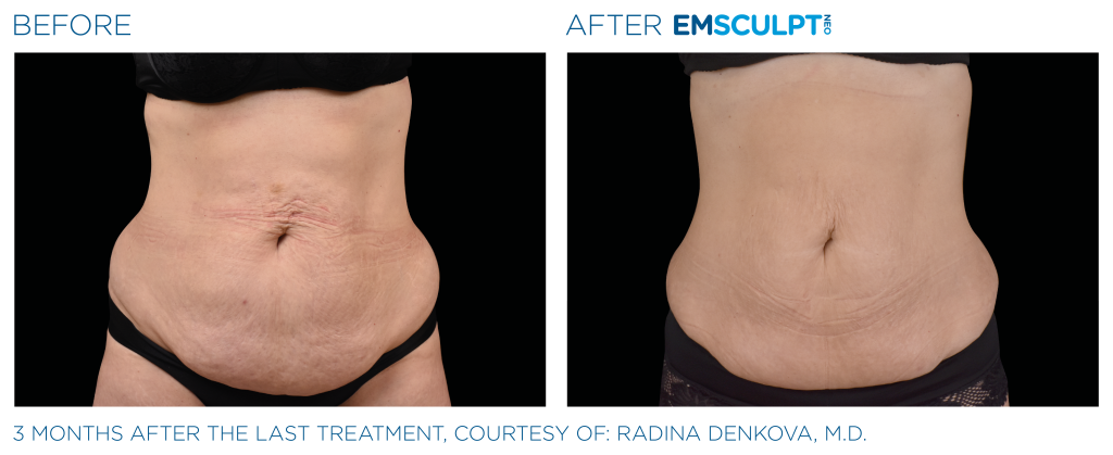 EMSCULPT NEO® pour le ventre