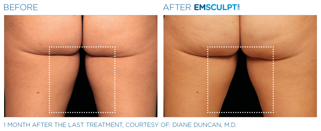 EMSCULPT NEO® pour les cuisses