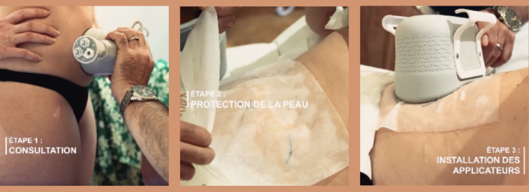 Étapes Cryolipolyse